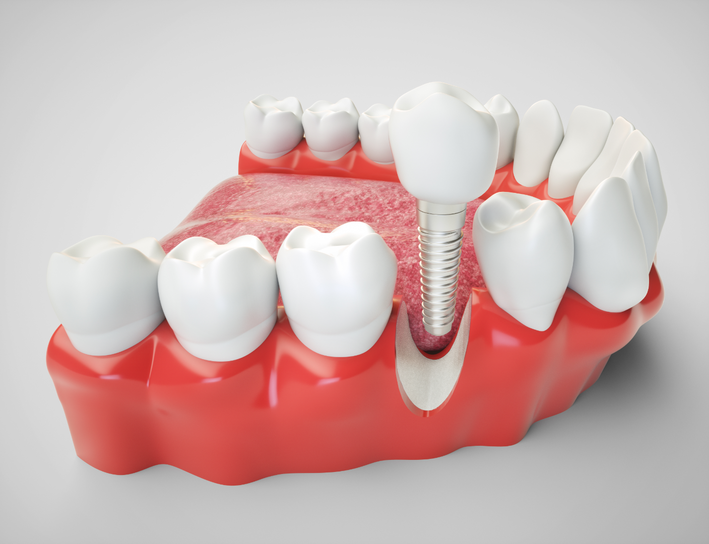 Dental Implants Middleton, MA