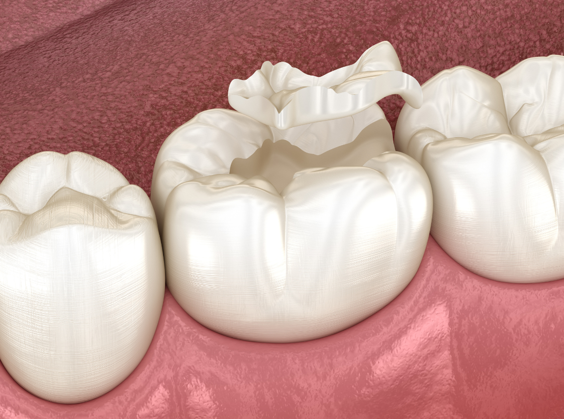 Mercury-Free Dentistry in Middleton, MA
