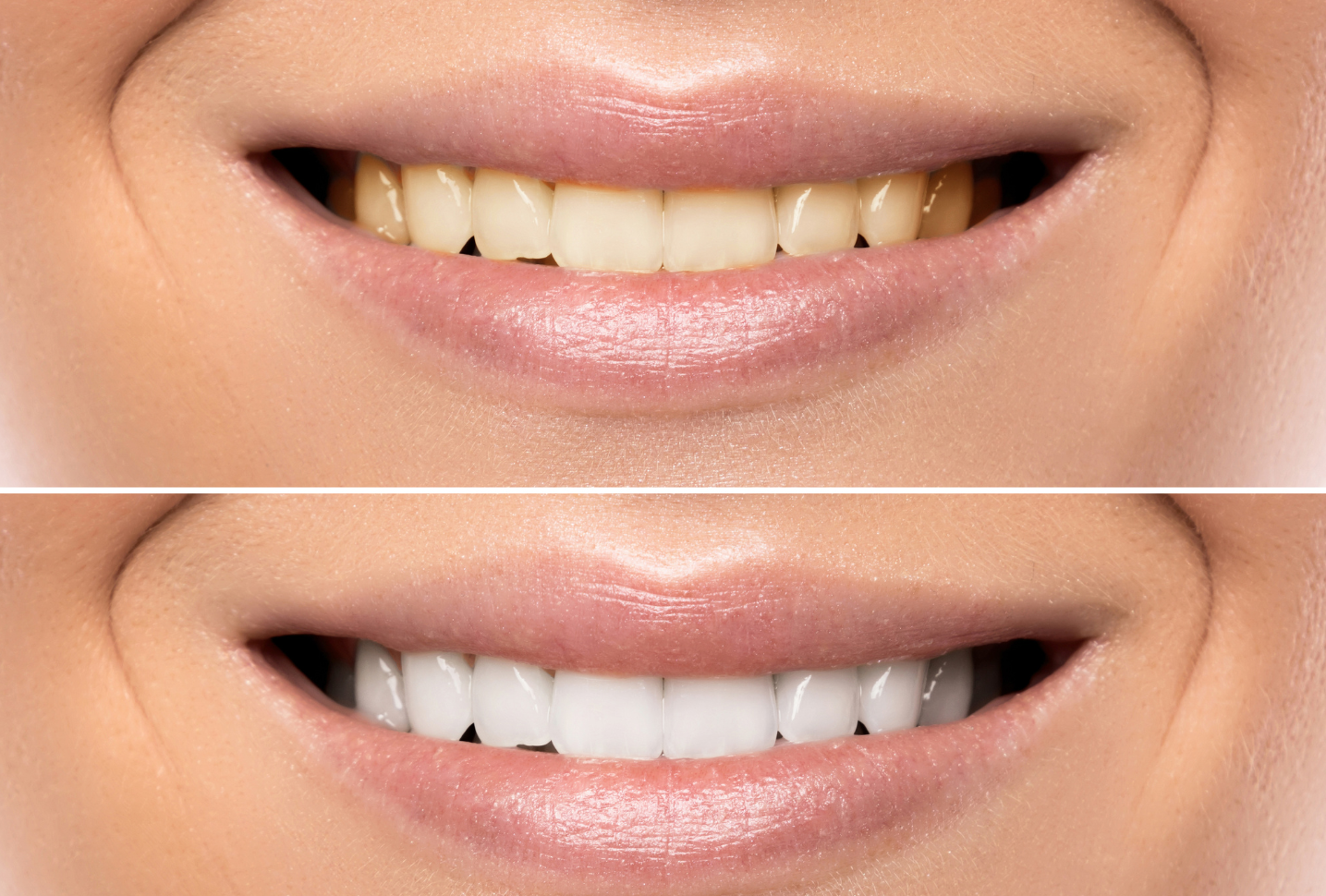 KöR Whitening in Middleton, MA