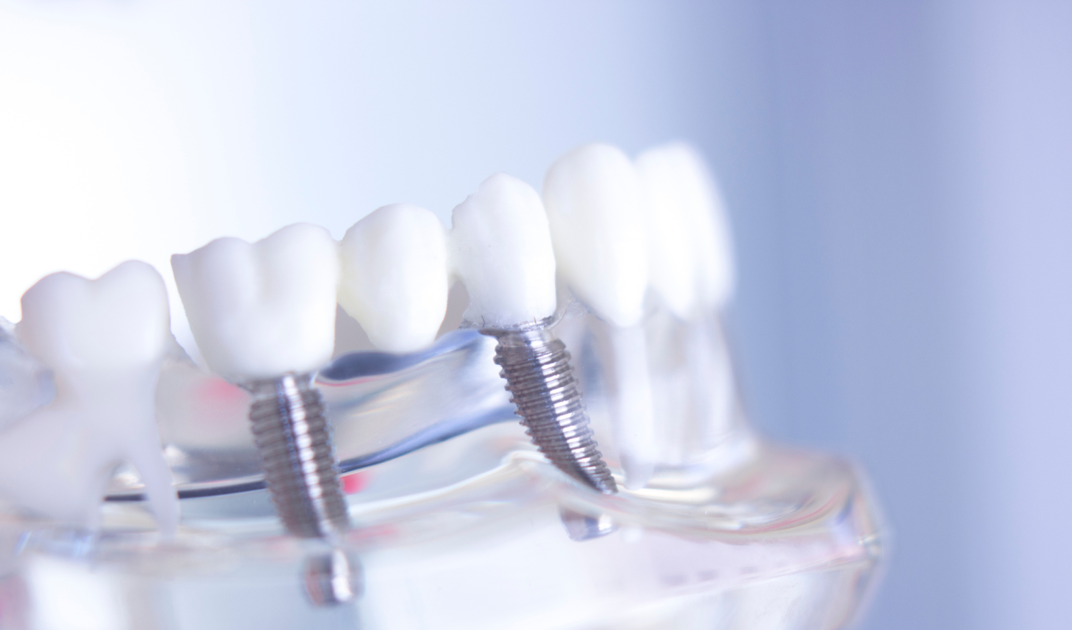 Hybridge Dental Implants in Middleton, MA